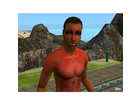 Sonnenbrand
